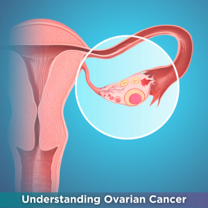 Understanding Ovarian Cancer Understanding Ovarian Cancer